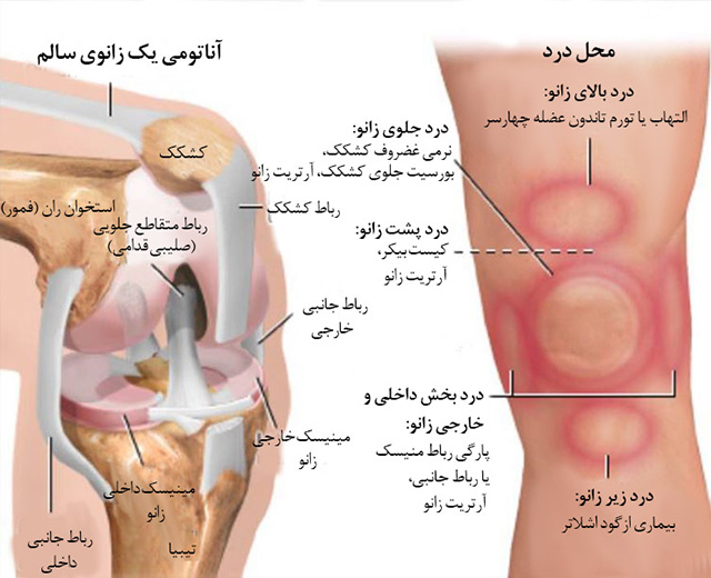 زانو درد